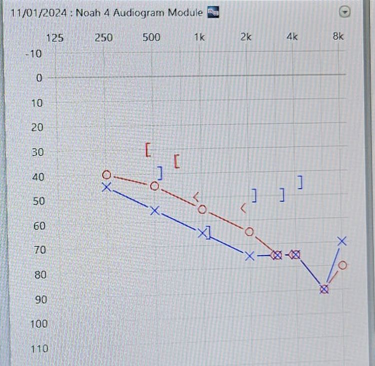 Typical age-related hearing loss: High-frequency nerves at cochlea entrance are more vulnerable.