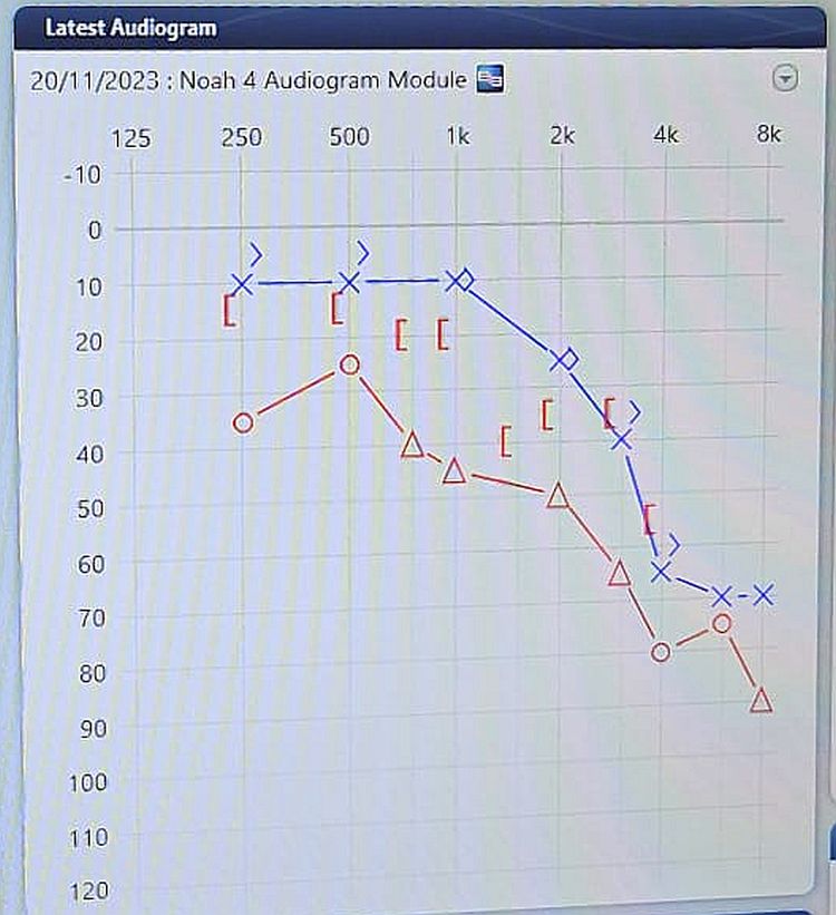Hearing test result typical of eardrum damage